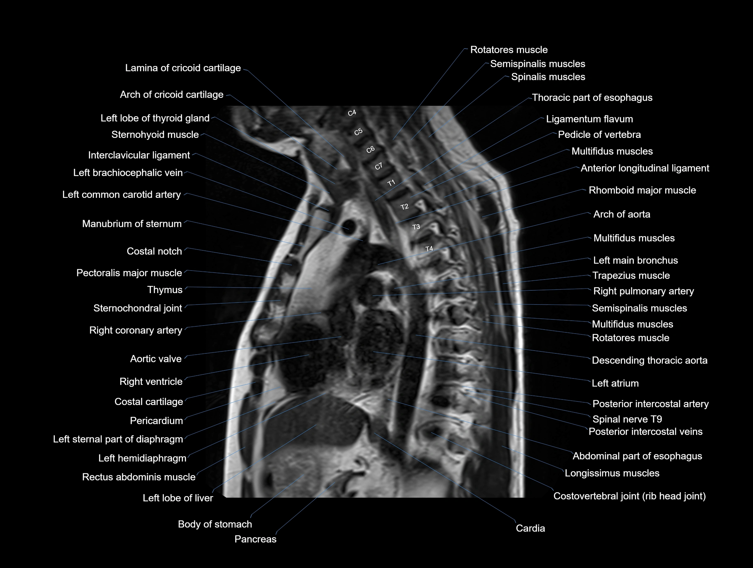 MRI chest (thorax) coronal  cross sectional anatomy 3T radiology  image-img-00001-00021.webp
